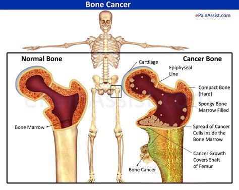 Bone Cancer | cancer | Pinterest | Bone cancer, Multiple ...