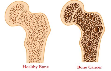 Bone Cancer : Causes, Symptoms, Stages, Types, Signs ...