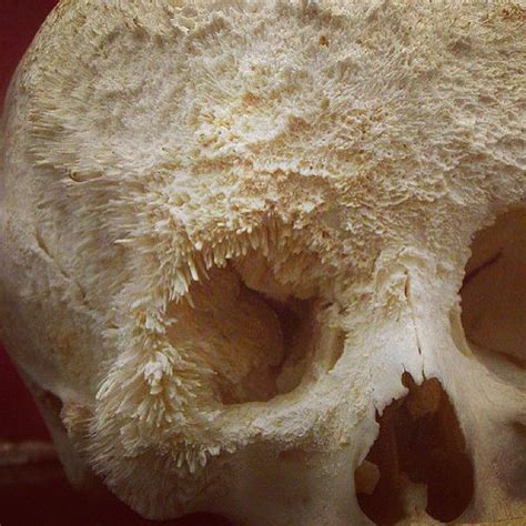 Bone Cancer Pictures Skull | Places to Visit | Pinterest ...