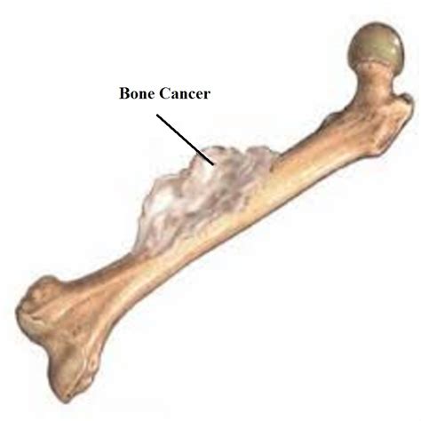 Bone Cancer Related Keywords   Bone Cancer Long Tail ...