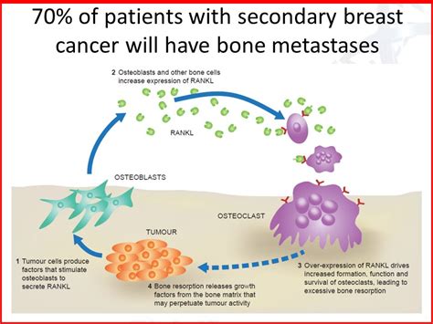 Bone Health Secondary Breast Cancer   ppt video online ...