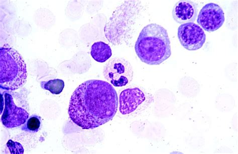 bone marrow smear, promyelocyte and erythroblasts | ALL ...