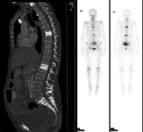 Bone metastases   CT and bone scan   Radiology at St ...