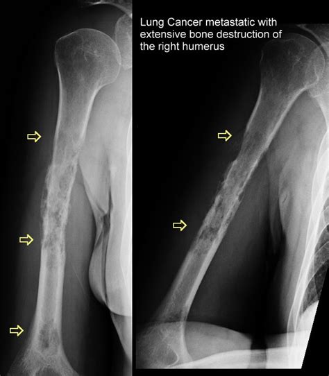 Bone Metastases Images and Xrays