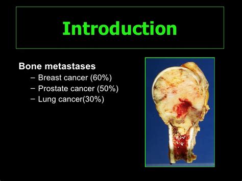 Bone Metastases of Bone Metastases