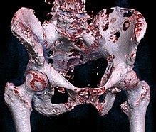 Bone metastasis   Wikipedia