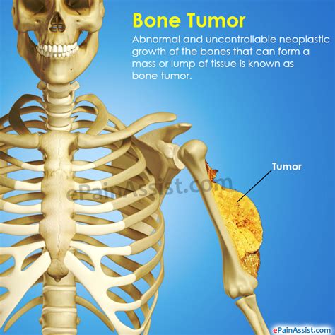 Bone Tumor|Types|Symptoms|Treatment|Survival Period