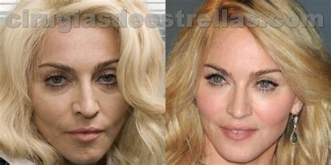 Botox de Madonna Cirugías de estrellas