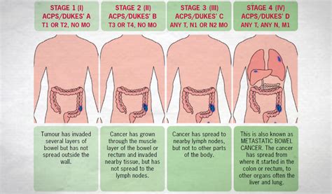 Bowel Cancer Staging   Size, Position & Spread