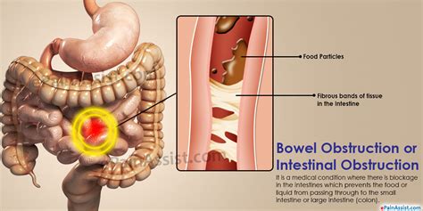 Bowel Obstruction: Treatment, Causes, Symptoms, Signs ...