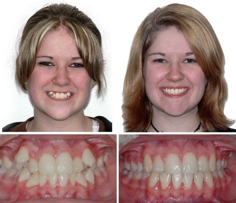 Braces Before and After Children & Family Dentistry ...