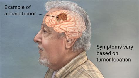 Brain Cancer   Life Expectancy, Symptoms, Types, Prognosis ...