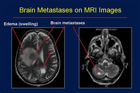 Brain Tumor Clinic   Brain Metastases