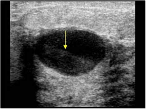 Breast and Axilla | 5.1 Benign lesions : Case 5.1.2 ...