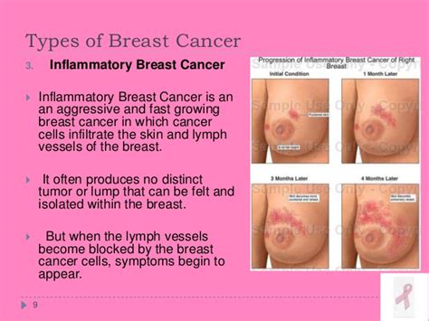 Breast Cancer