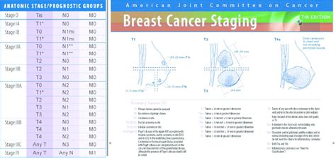 Breast cancer staging on the basis of TNM classification ...