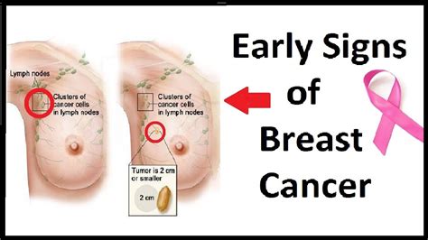 Breast Cancer Symptoms Early Signs | www.pixshark.com ...