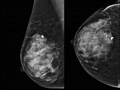 Breast Cyst; Breast Cysts