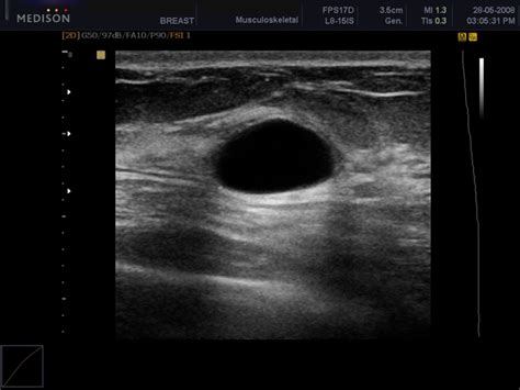 Breast cyst; Breast Cysts