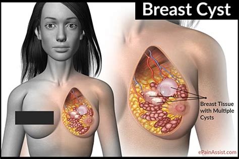 Breast Cyst|Causes|Symptoms|Treatment|Dos & Don’ts