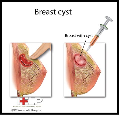 Breast Cyst | Female Reproductive System | Pinterest