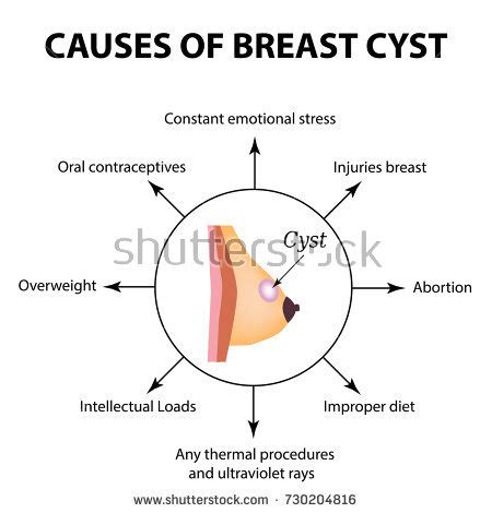 Breast Cyst Stock Images, Royalty Free Images & Vectors ...