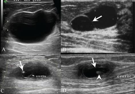 Breast Cyst Vs Tumor | www.imgkid.com The Image Kid Has It!