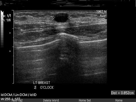 Breast cysts by Professor Kefah Mokbel | totalhealth