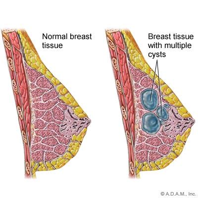 Breast cysts Women Health Info Blog