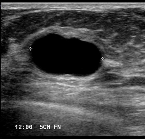 breast pathology ultrasound