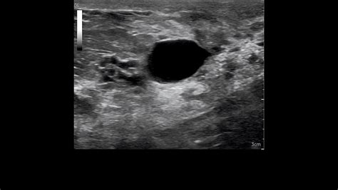 Breast Ultrasound: Breast Ultrasound Images Cancer