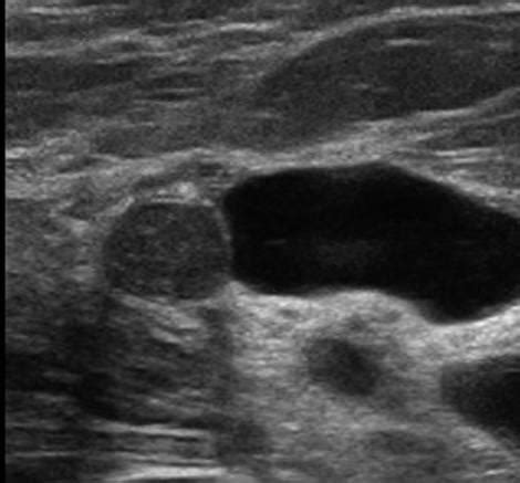 Breast Ultrasound: Cysts In Breast Ultrasound Images