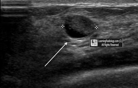 Breast Ultrasound: Cysts In Breast Ultrasound Images