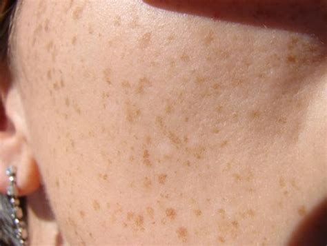 Brown Spots Appearing on Skin