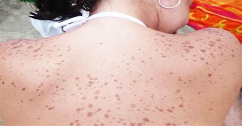 Brown spots, Brown spots on skin and Spots on skin on ...
