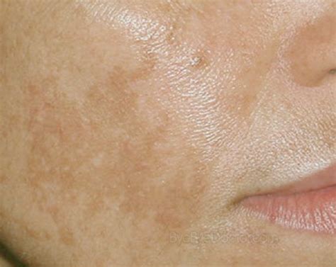 Brown Spots on Face | Symptoms Causes Treatment and ...