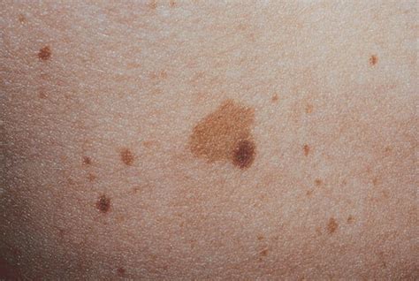 Brown Spots On Skin   Causes, Symptoms, Treatment ...