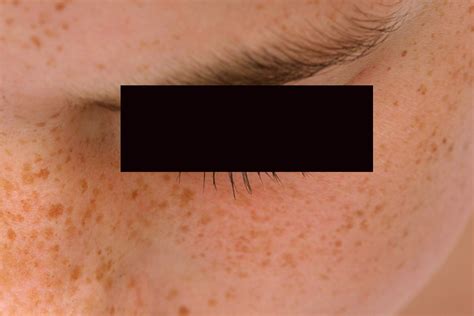 Brown Spots on Skin   Pictures, Causes, Home Remedies ...