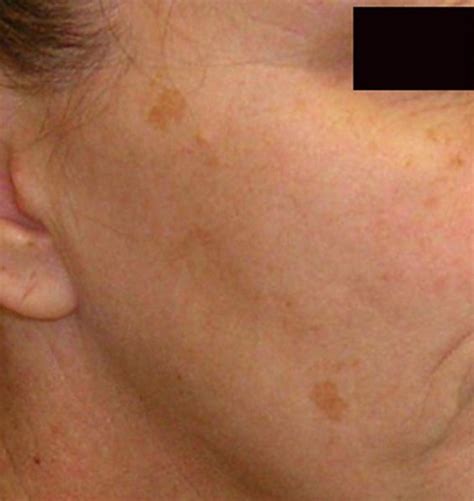Brown Spots on Skin   Pictures, Causes, Home Remedies ...