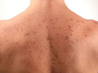 Brown Spots treatment at Mayoral Dermatology, a Cosmetic ...
