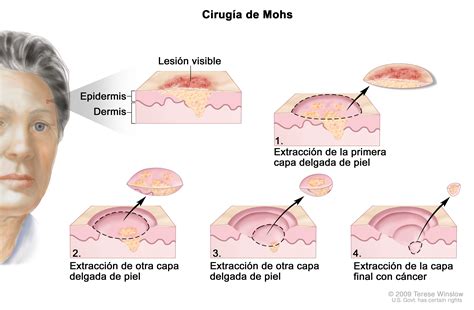 CÃ¡ncer de piel: Tratamiento  PDQ®  | Cure Today