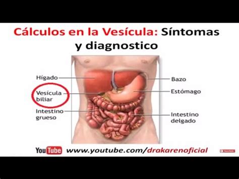 Cálculos en la vesícula: Síntomas de la Colelitiasis   YouTube