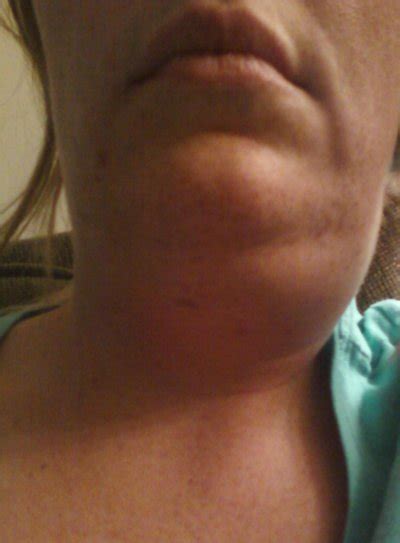 Can Lipodissolve Under Chin Damage the Submandibular ...