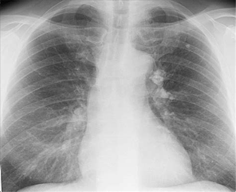 Can you live with pulmonary nodules?   mccnsulting.web.fc2.com