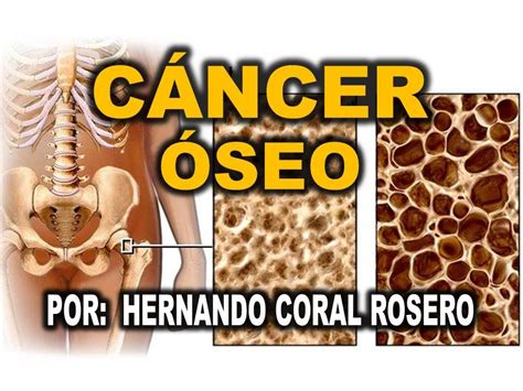 Cancer A Los Huesos Pictures to Pin on Pinterest   ThePinsta