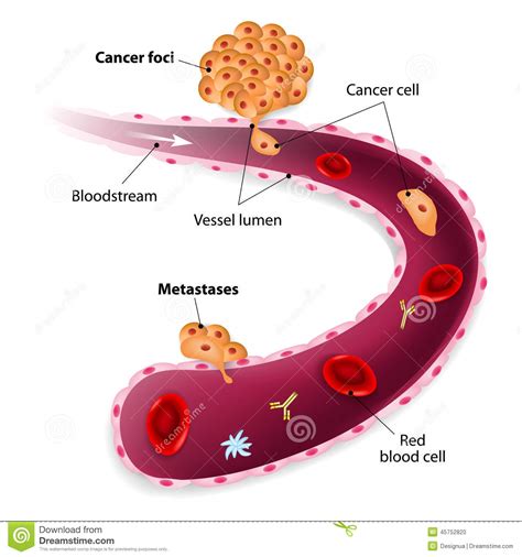 Cancer Cells, Cancer Foci And Metastases Stock Vector ...