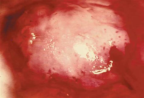 Cancer De Cervix Grado 3 B | ginecologia y obstetricia 191 ...