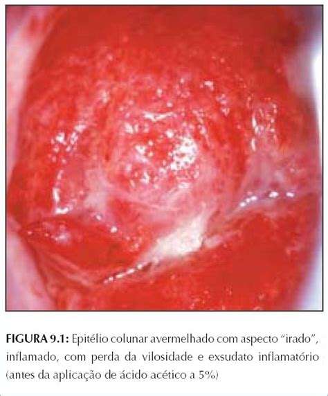 Cancer De Cervix Grado 3 B | laparoscopia quir 250 rgica ...