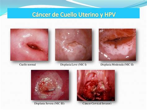 Cancer De Cervix Grado 3 B | laparoscopia quir 250 rgica ...
