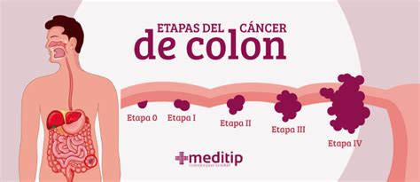 Cáncer de colon: causas, síntomas y diagnóstico   Meditip
